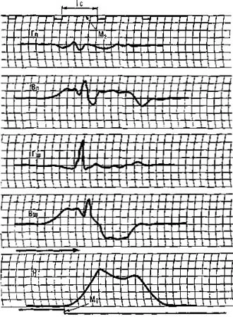 Five chart-recorder traces of force and bar height during a snatch